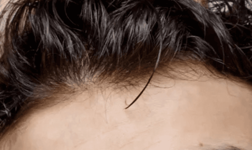 Close-up of hairline to show hair thinning – Hair loss treatment savings for disabled people through Purpl health offers.